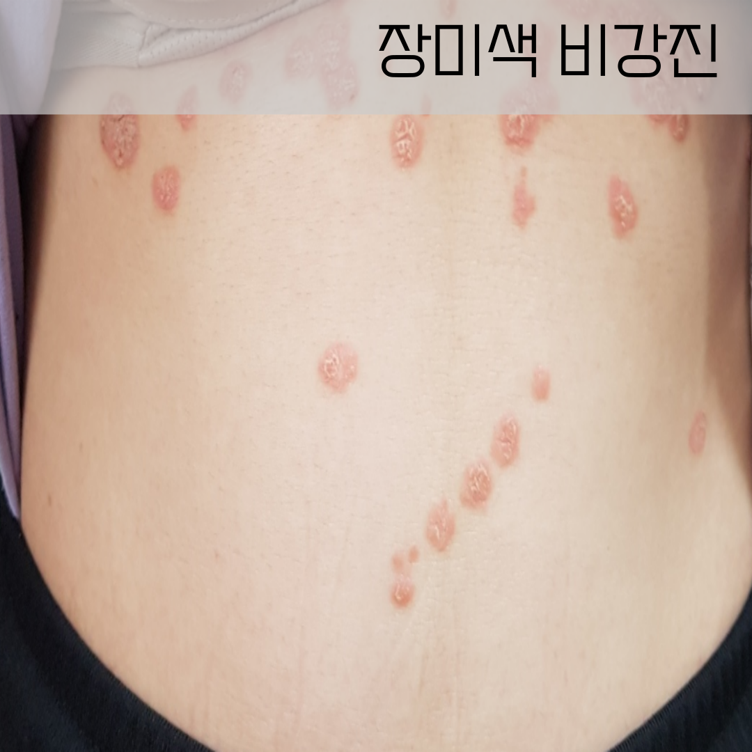 장미색비강진한의원, 건선한의원, 각질피부한의원, 달서구 비강진한의원 , 두드러기 월배 한의원