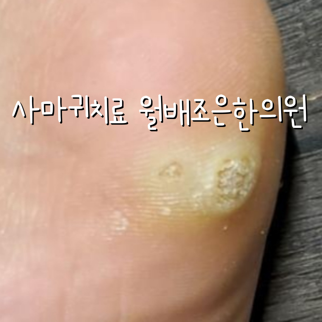 번지는사마귀치료, 발바닥사마귀, 사마귀한약, 율무사마귀, 사마귀의이인