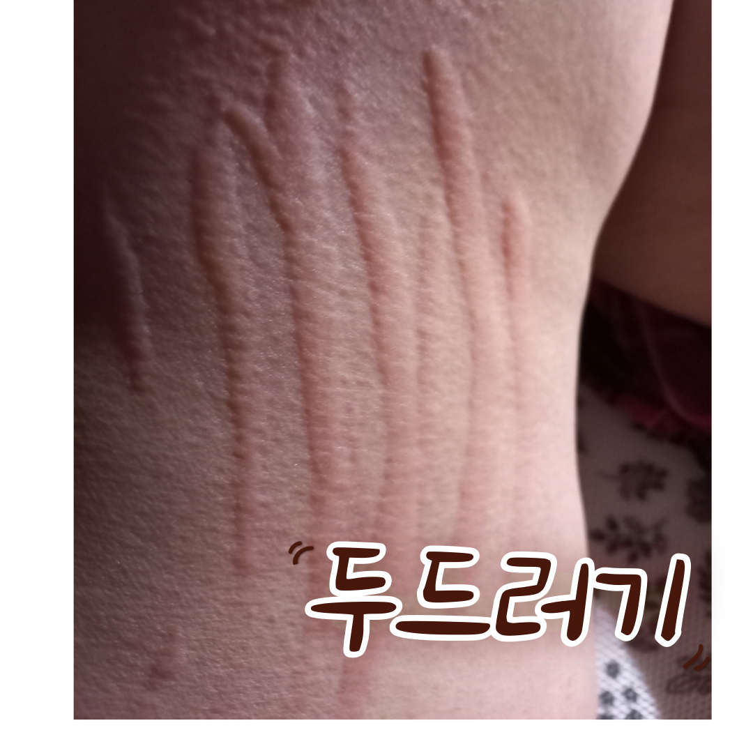 두드러기한약치료,달서구두드러기,월배두드러기