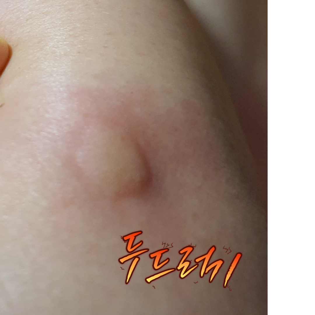 두드러기한약