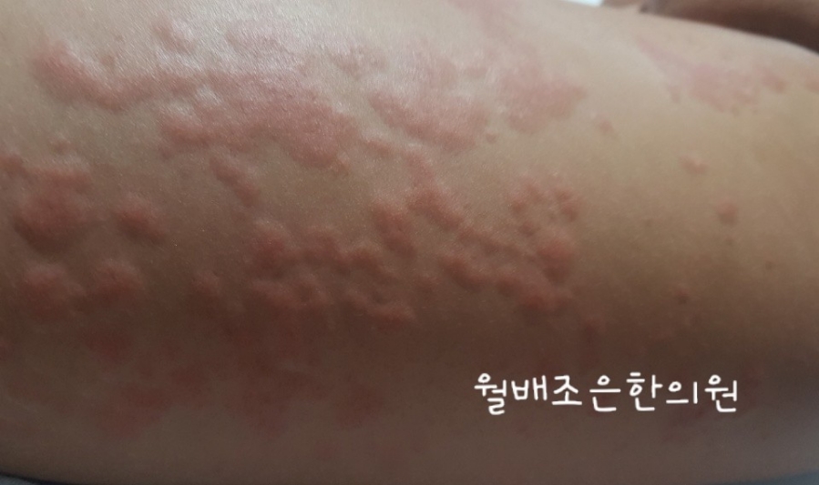 두드러기한의원